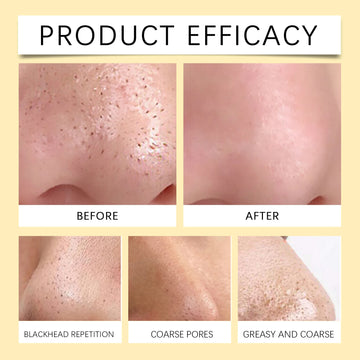 EELHOE Blackhead Remover