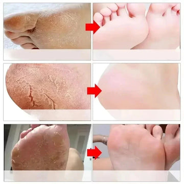 Herbal Anti Crack Foot Cream Spray