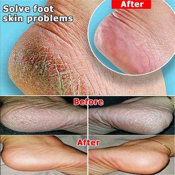 Herbal Anti Crack Foot Cream Spray