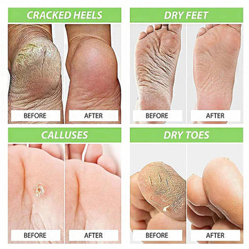 Herbal Anti Crack Foot Cream Spray
