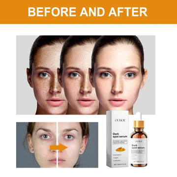 Ouhoe 30ml Dark Spot Removal Serum